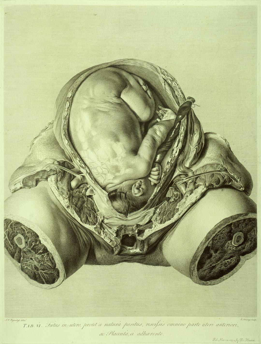 The Gravid Uterus, William Hunter, drawn by Jan van Rymsdyk